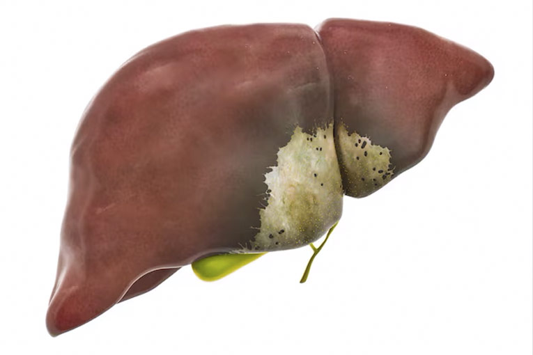 Liver Cirrhosis | JSS Hospital Blog