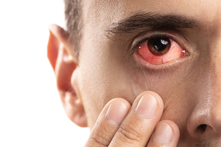 Autoimmune Eye Disorders | JSS Hospital Blog