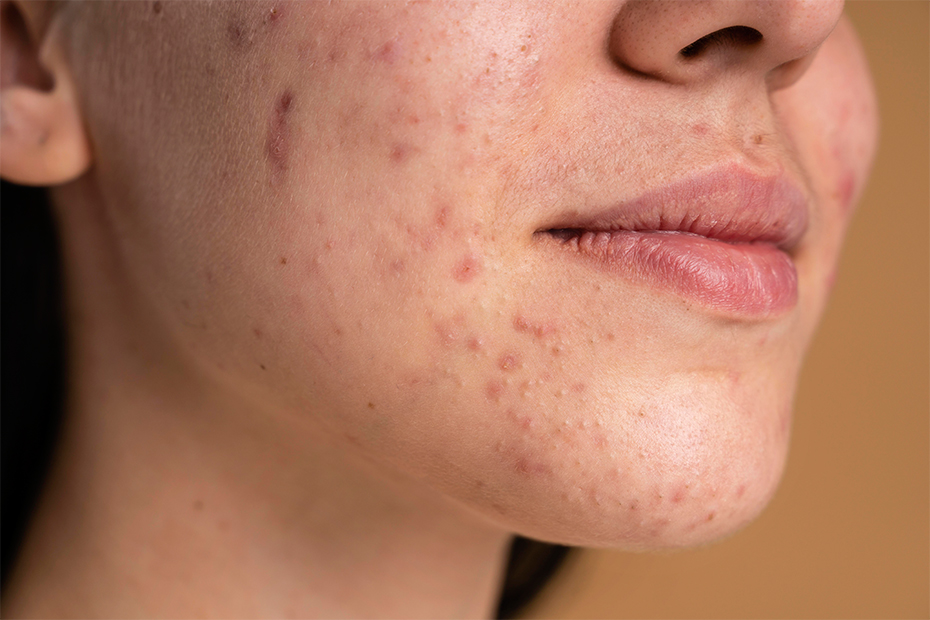 What Causes Acne Scars?