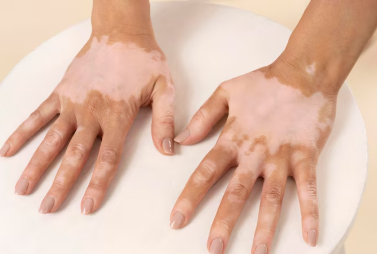 Vitiligo Surgery: Bringing Colour Back to Lives