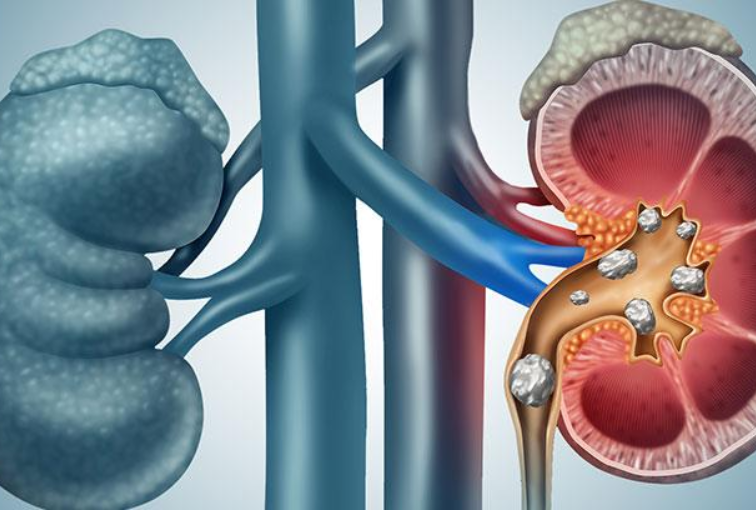 10 Early Signs of Kidney Stones You Shouldn't Ignore