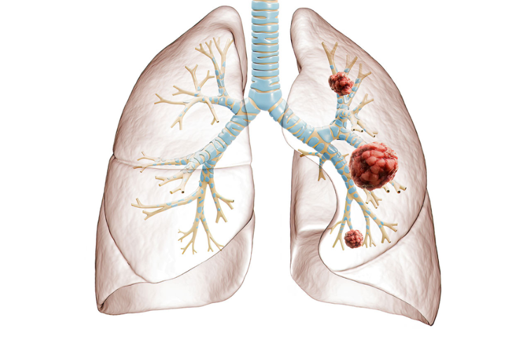 Lung Cancer: Four Warning Indications That Could Start Early in the Morning